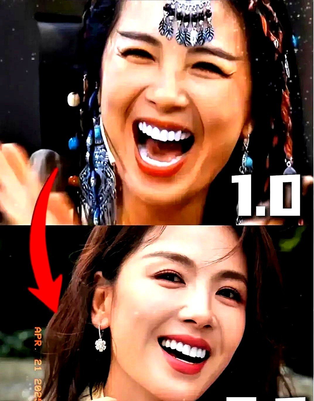 牙齿贴面的价格?牙齿贴面怎么贴?(图1)