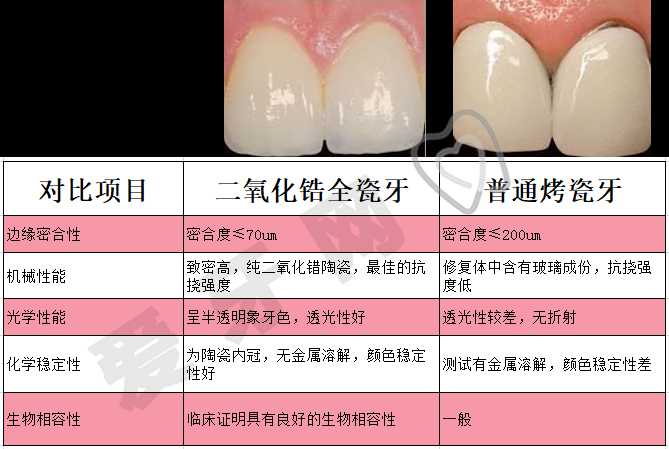 烤瓷牙使用寿命是几年(图1)