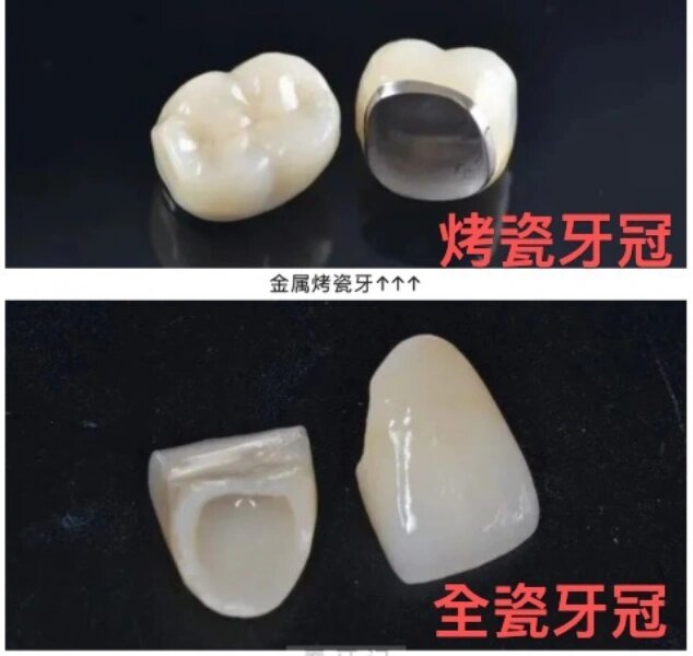 烤瓷牙寿命一般多少年(图1)