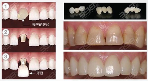 全瓷牙和烤瓷牙修复对比图(图1)
