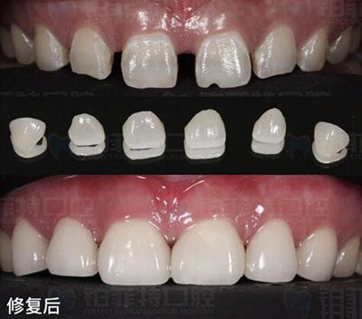 全瓷牙套前后对比图(图1)