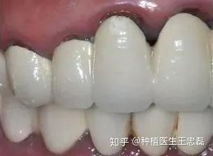 烤瓷牙通常多久需要更换(图1)