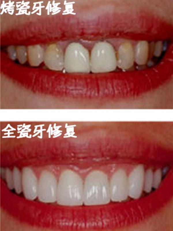 牙齿断了怎么办(图1)