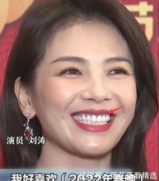 烤瓷牙种类(图1)
