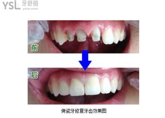 牙套矫正的全过程动画(图1)