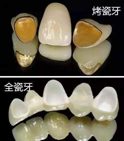 牙科金属全冠的制作工艺欣赏(图1)