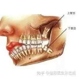 隐形牙齿矫正多少钱？成人牙齿矫正多少钱？(图1)