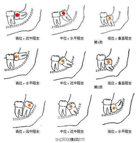 拔智齿脸会垮掉吗(图1)