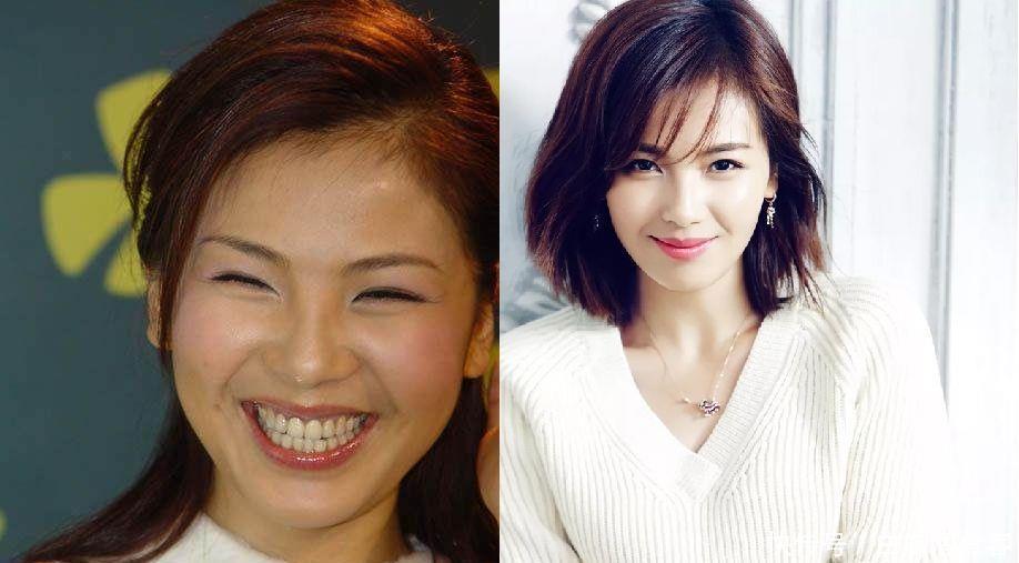 牙齿做美容冠有什么坏处?(图1)