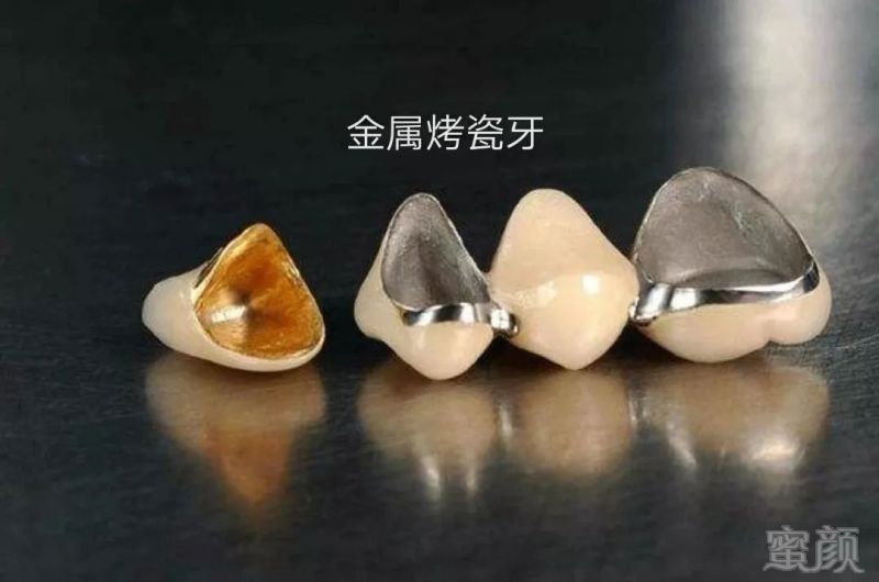 牙齿瓷贴面费用?牙齿瓷贴面维持多久?(图1)