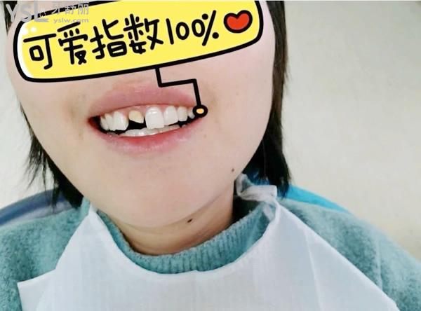 烤瓷牙通常多久需要更换一次(图1)