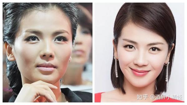 美容冠牙齿能用多久?做美容冠牙齿矫正多少钱?(图1)