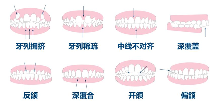 牙齿矫正最佳年龄(图1)
