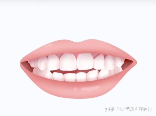 矫正牙齿多少钱啊?牙齿美白多少钱啊?(图1)